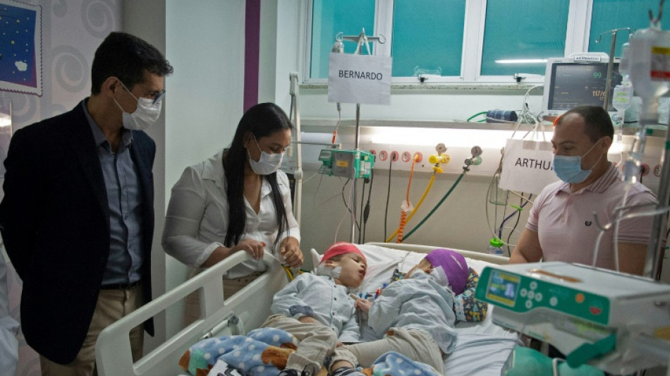 Siameses brasile&ntilde;os unidos por el cr&aacute;neo, separados con ayuda de realidad virtual